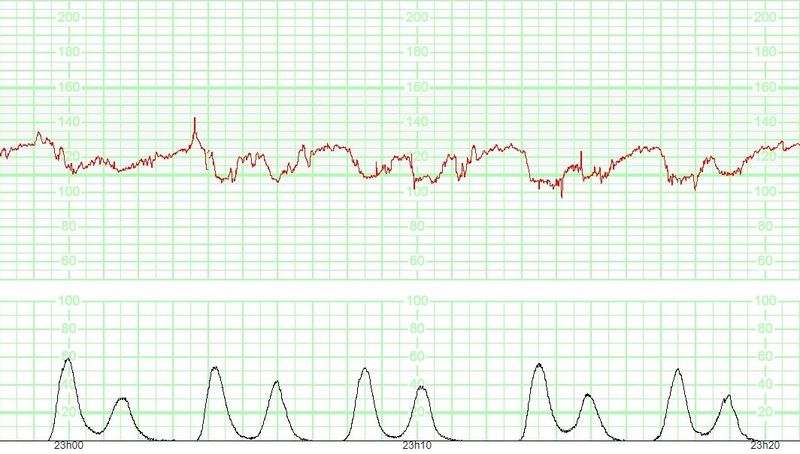 Des contractions bigéminées